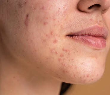 Acne & Pigmentation